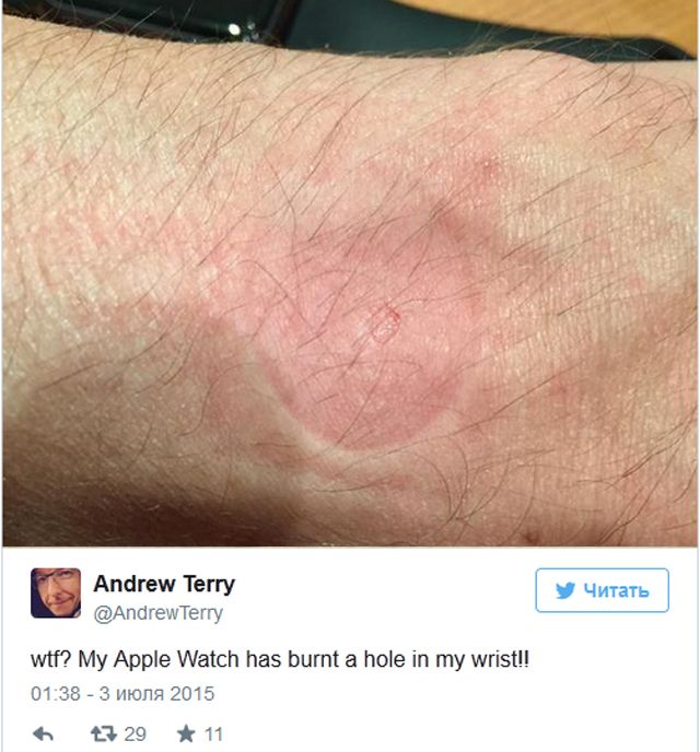  Apple Watch, Fitbit, раздражение, ожоги 
